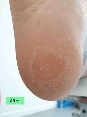 c.smith-resolved-heel-1